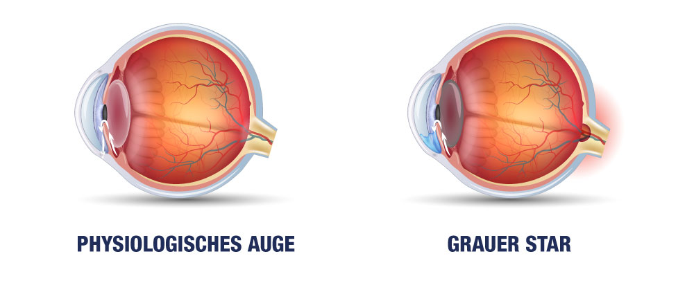 Grauer Star Katarakt Operation Verlauf Infos IClinic